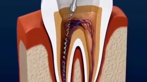 Root canal treatment (endodontics)