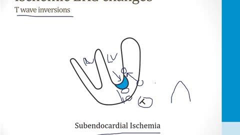 Cardiology - 2. Cardiac Ischemia - 2.Cardiac Ischemia
