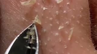 Satisfying removal of whiteheads on nose