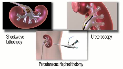 Observation Non-surgical Approach to Kidney Stones