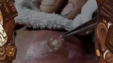 Pimple popper and blackhead