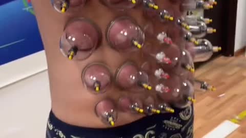 Cupping therapy