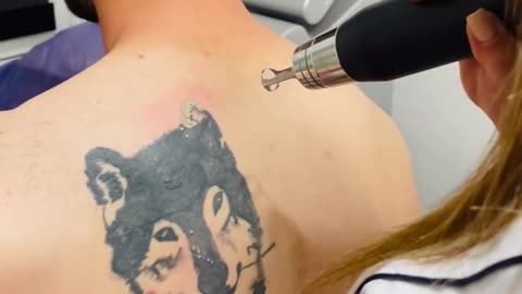 Removing body tattoos with a laser machine!!