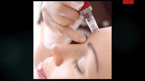 Microneedling in Sandymount