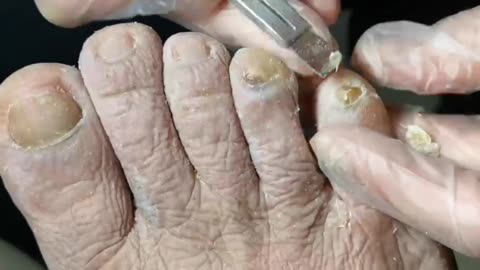 Fungal nails #11 Pedicure tutorial