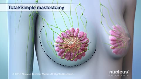 What Happens During a Total, or Simple, Mastectomy