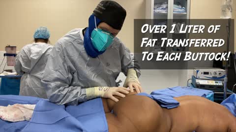 Brazilian Buttock Lift /BBL/ Fat Transfer to Buttocks for Reconstruction after Removal of Silicone