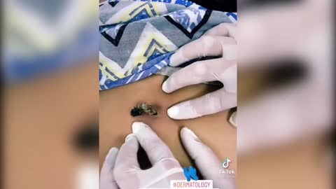 Popping huge blackheads and Pimple Popping
