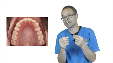 Problems with Upper Fixed Retainers By Dr Mike Mew