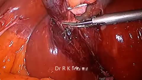 Golbblader Stone Loproscopy Operation.Video