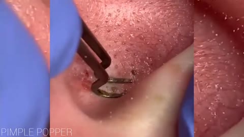 Satisfying Ear Pimple Popping Videos