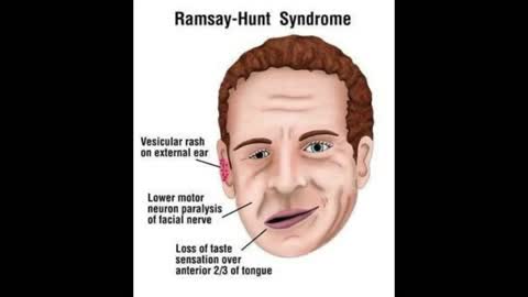 Justin Bieber & Ramsay Hunt Syndrome