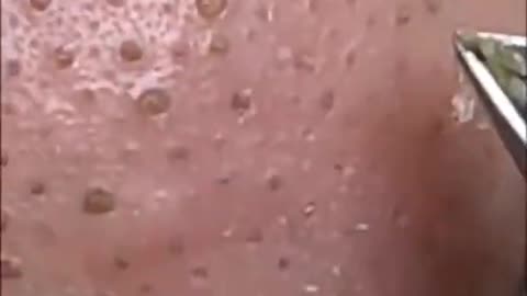 Satisfying Blackhead Removal Using a Nipper