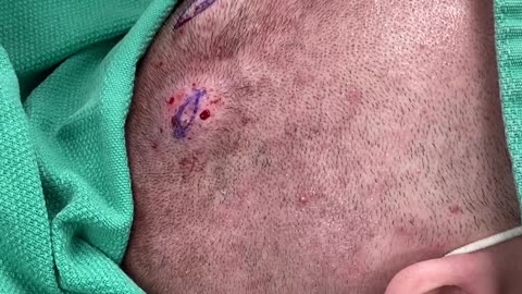 Pilar Cyst on Scalp Removed