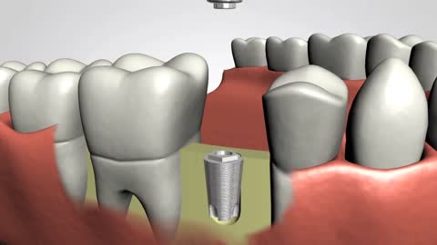 Dental implants