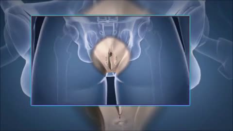 Surgery | Sex reassignment: Man - Woman