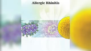 Allergic Rhinitis