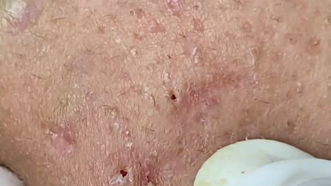 Extreme Blackhead Removal at NaSa Skin Care #2408