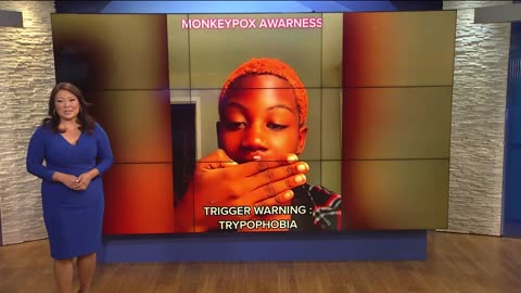 Georgia woman raises awareness on Monkeypox