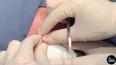 A ＂Parasite＂ Cyst Removal