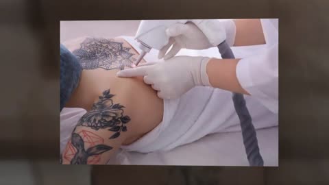 Tattoo Removal Fort Myers FL