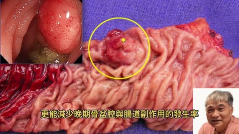 電熱治療 提高大腸直腸癌療效