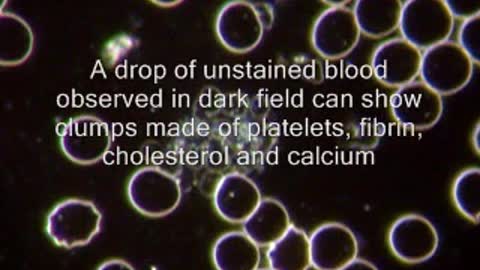Dark Field Microscopy and Thrombosis