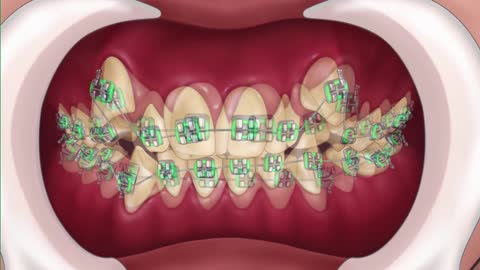 AMAZING reconstruction of tooth damaged by caries:
