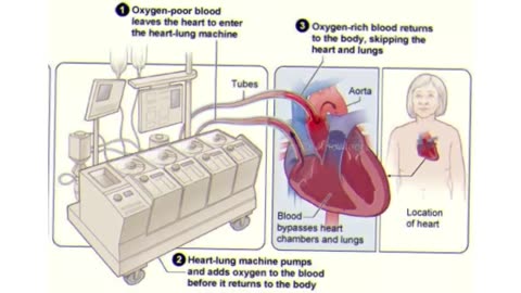 How Does Heart Bypass Surgery Works? | Open Heart Surgery (Urdu/Hindi)