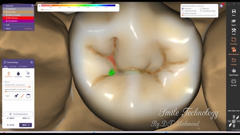 #exocad #exoplan #cadcam #exocad #exoplan #cadcam