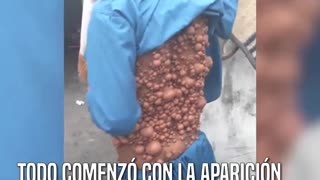 Lo conocen como “el hombre burbuja”