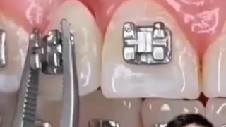 Fixing missing tooth with braces