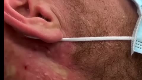 Saucy Blackheads