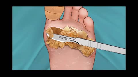 Immersive pedicure, surgical removal of large plantar warts animation