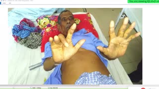 ST5.55-year-old male presented with jaundice