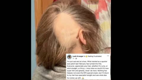 WHAT A DUMB BITCH! Woman who shamed the unmasked is now balding because of the vaccine