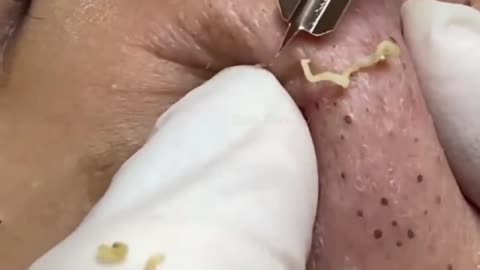 Cleaning Too Many Blackheads