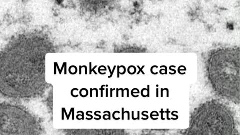 Monkeypox case confirmed in Massachusetts