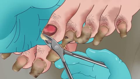 ASMR Climber's plantar rot toenails care animation | 등산가의 발바닥 썩은 발톱 관리 애니메이션