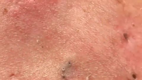 VERY BIG LARGE BLACKHEADS REMOVAL 2022 #satisfying #blackheads #pimple #popping