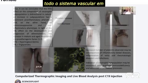 Imagem termográfica mostra coágulos sanguíneos maciços no Vaxxed assintomático