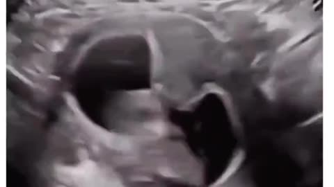 Baby In Womb With Hiccups