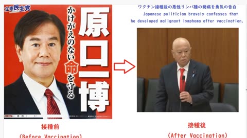 Japanese MP: Malignant Lymphoma after vaccination and lost his hair as a consequence..