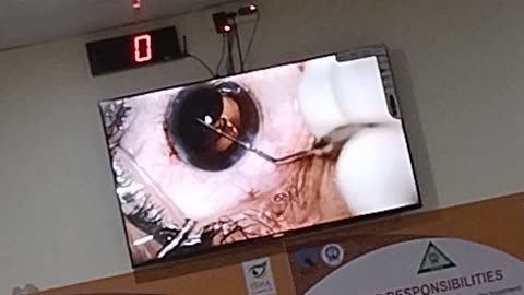 Cataract surgery