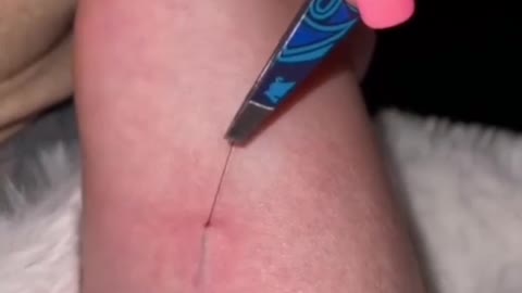 The Ultimate Guide to DIY Deep Splinter Removal