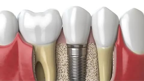 Dental implants Kenosha WI | Pat Crawford DDS