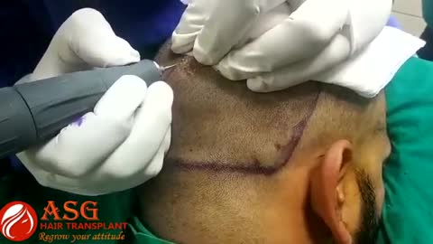 FUE Hair Transplant Technique - Extraction of Grafts
