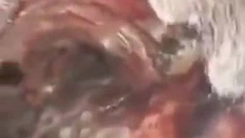 GRAPHENE OXIDE IN THE LUNGS & ESOPHAGUS OF A VAXXED PATIENT
