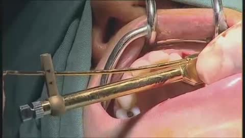 NobelActive clinical case: immediate implant placement