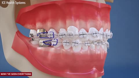 How braces work